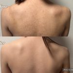エアブラシでお背中のニキビ痕を綺麗に隠すボディメイク