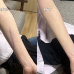 京都の花嫁様のご自宅へエアブラシによる傷痕隠し