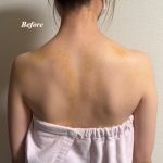 エステでできたアザをボディーメイクでカバー
